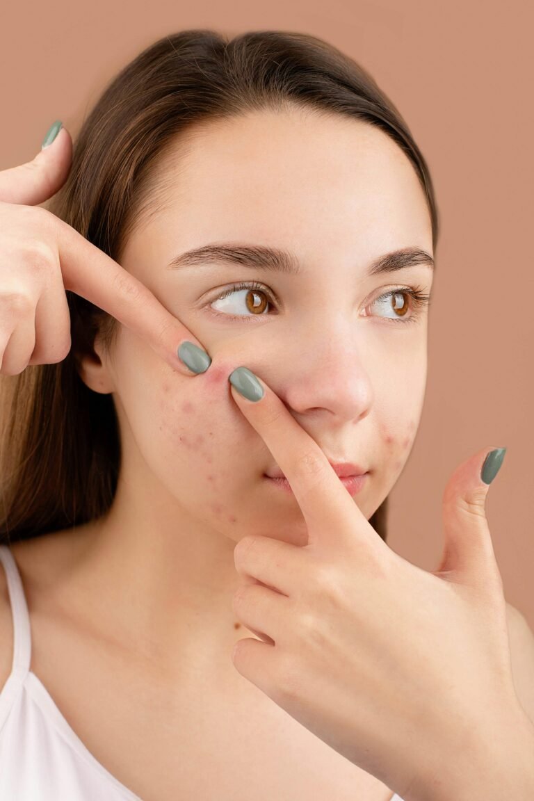 Acne Breakouts on the face