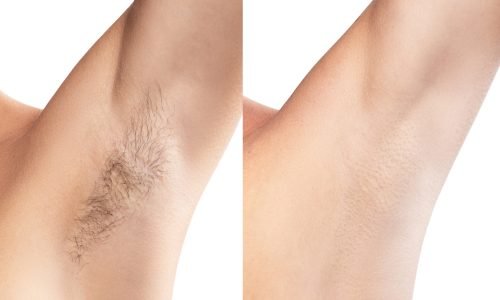 Best laser hair removal in Mumbai